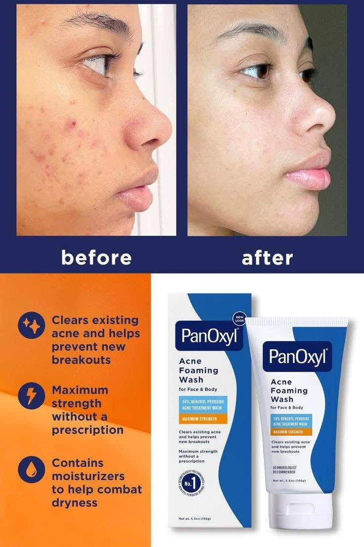 💥 𝐏𝐚𝐧𝐎𝐱𝐲𝐥 𝐀𝐜𝐧𝐞 𝐅𝐨𝐚𝐦𝐢𝐧𝐠 𝐖𝐚𝐬𝐡 𝟏𝟎% 𝐁𝐞𝐧𝐳𝐨𝐲𝐥 𝐏𝐞𝐫𝐨𝐱𝐢𝐝𝐞 – 𝐌𝐚𝐱𝐢𝐦𝐮𝐦 𝐒𝐭𝐫𝐞𝐧𝐠𝐭𝐡 (𝟏𝟓𝟔𝐠)